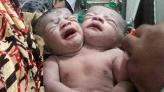 تولد نوزادی در بنگلادش با 2 سر +عکس