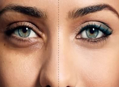 بهترین روش درمان برای رفع سیاهی دور چشم