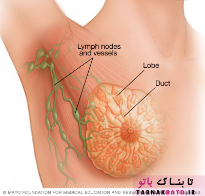 سرطان سینه یا پستان؛ عوامل، علائم و درمان بیماری