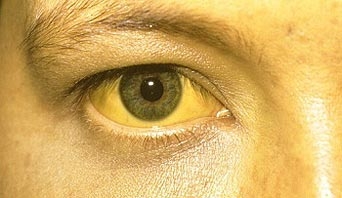 کشف بیماری های پنهان از شکل و رنگ چشم ها