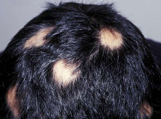 علل رایج برای ریزش موی سکه ای