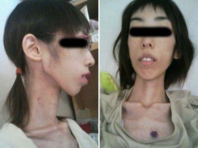 شکنجه دختر جوان ژاپنی که فقط ۱۷ کیلو وزن دارد +عکس