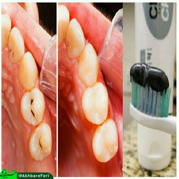 خمیر دندانی که دندانپزشکان را بیکار می‌کند+عکس