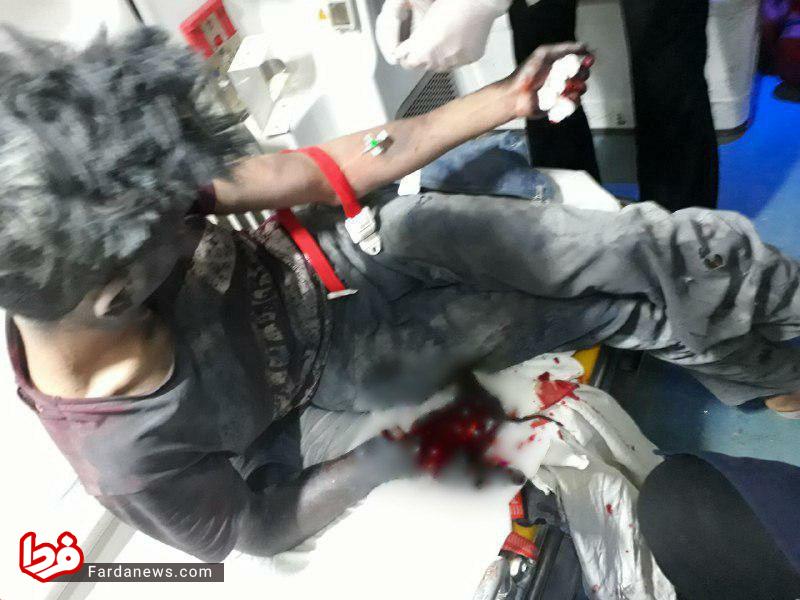 قطع دست نوجوان ۱۶ ساله در انفجار ترقه +عکس