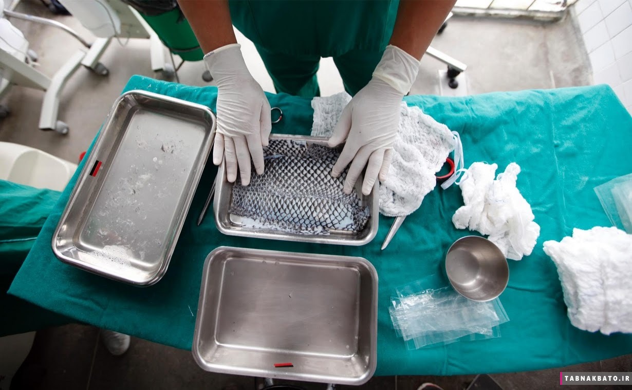درمان نوین سوختگی با پوست ماهی در برزیل