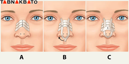 مراقبت های بعد از عمل جراحی زیبایی بینی