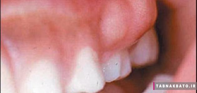 عفونت ریشه دندان و لثه چگونه درمان می شود؟