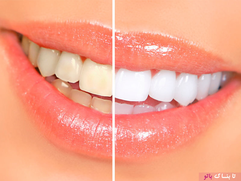 هفت اشتباهی که منجر به جرم دندان می شود