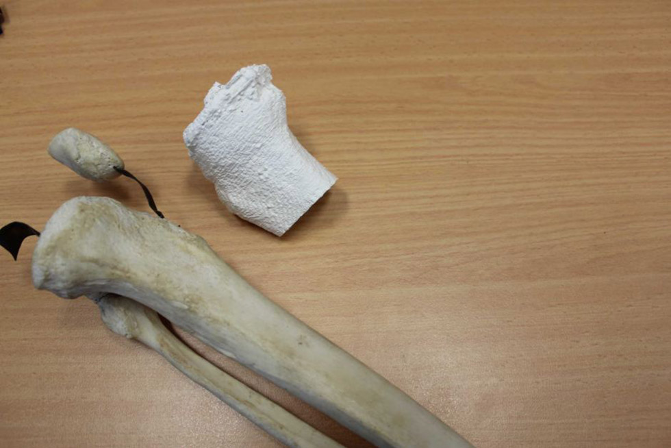 پیوند استخوان با پرینتر سه بعدی به ساق پای انسان