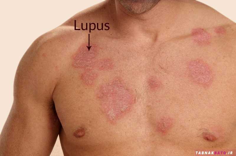 بیماری لوپوس چیست؟