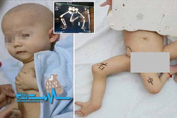 حذف پای سوم از بدن کودک ۱۱ ماهه +عکس