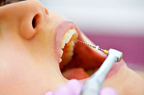 عصب کشی دندان چگونه انجام می‌شود؟