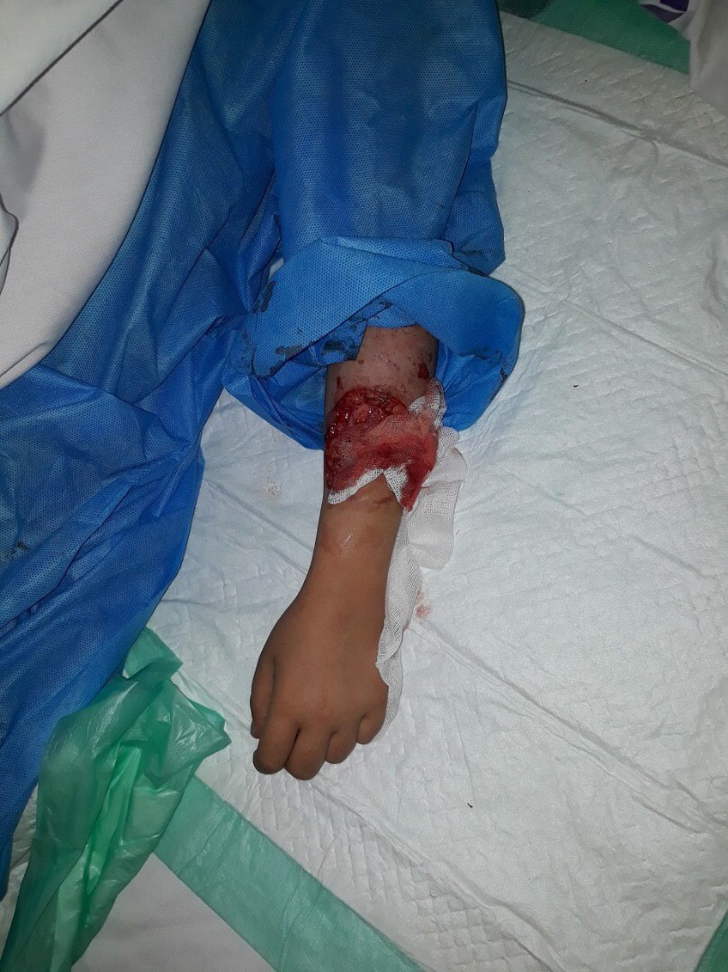 سگ‌های شکاری به یک دختربچه در لواسان حمله کردند +تصاویر