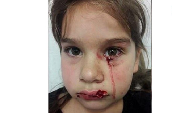 حمله سگ وحشی به دختر ۵ ساله در فرودگاه +عکس