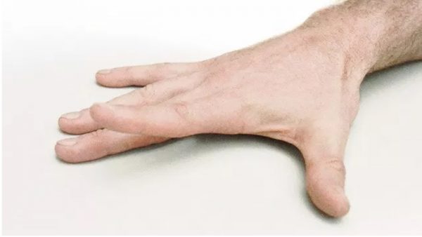 7 ورزش دست برای درمان درد آرتروز