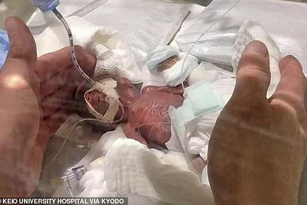کوچک‌ترین نوزاد پسر دنیا زنده ماند+تصاویر