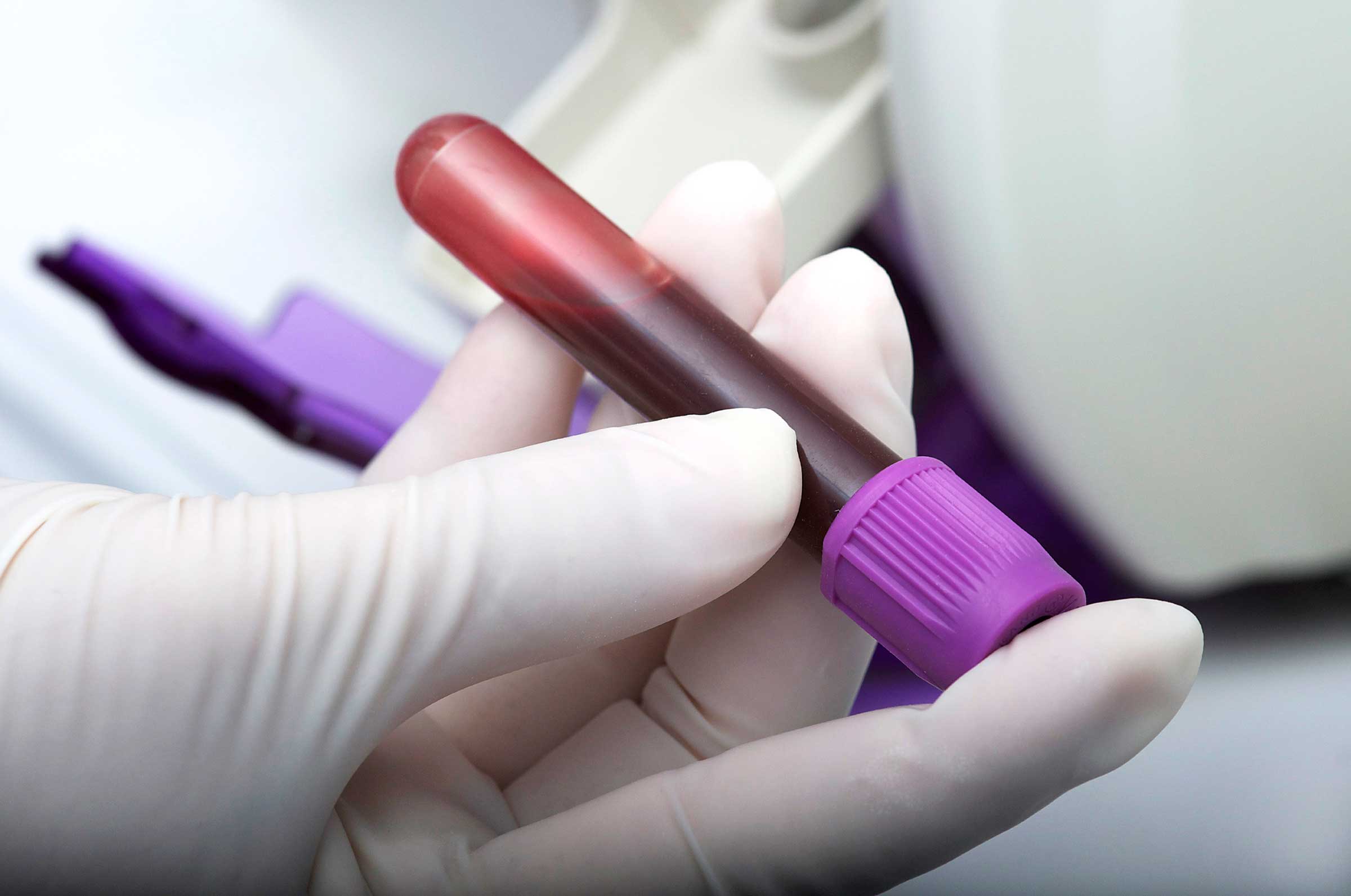 تشخیص زودهنگام 8 سرطان با این آزمایش خون ساده