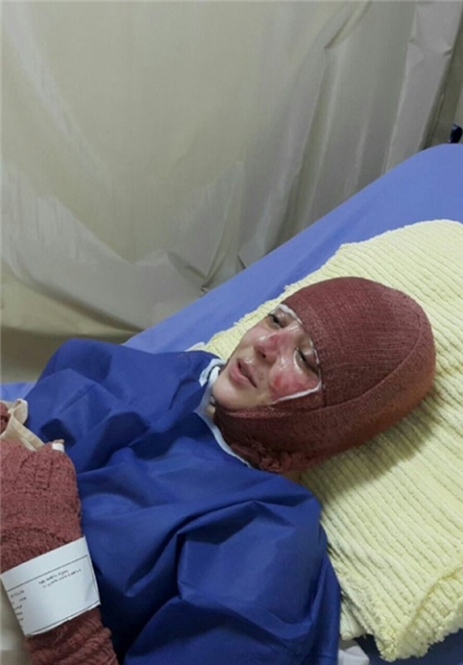آخرین وضعیت درمانی قربانی اسید پاشی تبریز +تصاویر
