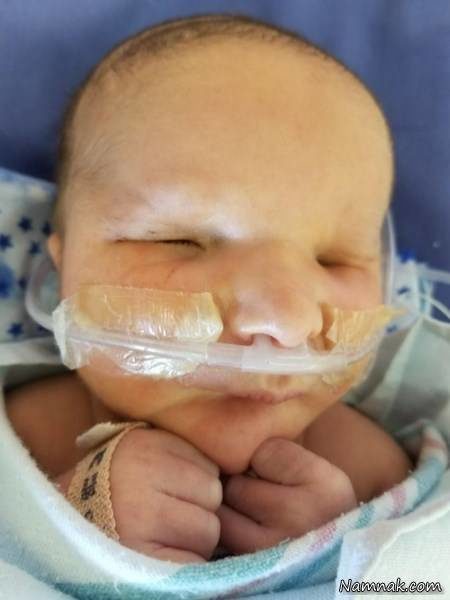 تولد نوزاد بدون چشم همه را شوکه کرد+تصاویر