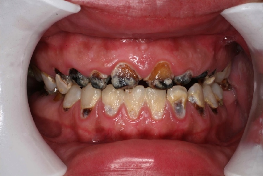 مضرات دندان پوسیده چیست؟