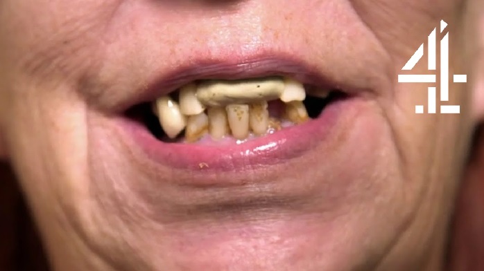 مضرات دندان پوسیده چیست؟