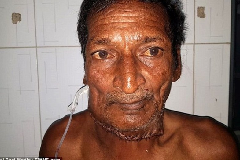 جراحی تومور عجیب در گردن مرد هندی +تصاویر