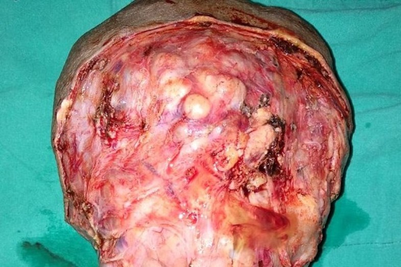 جراحی تومور عجیب در گردن مرد هندی +تصاویر