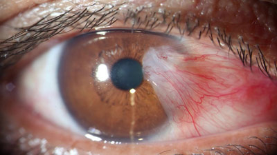 ناخنک چشم چیست؟ علائم و درمان ناخنک چشم