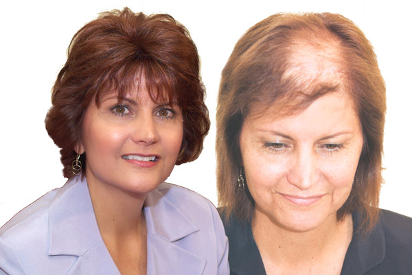 درمان ریزش مو در خانم ها با چند توصیه خانگی!