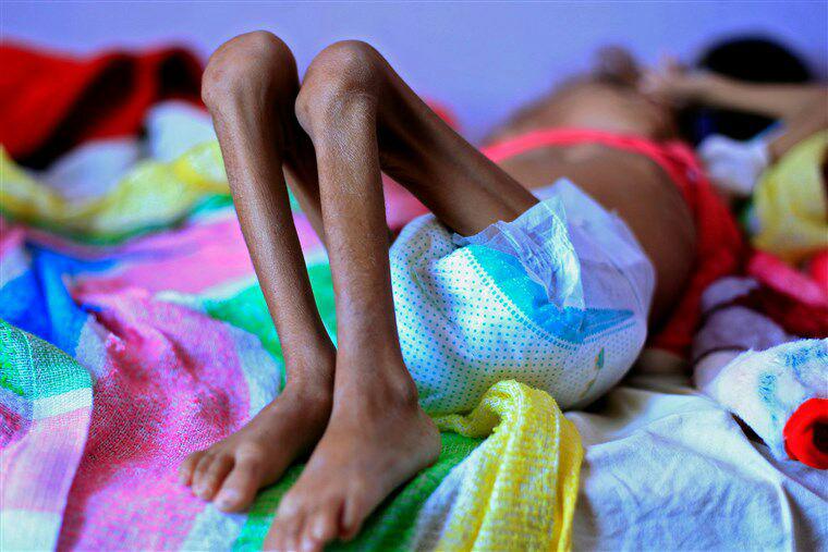دردناک ترین تصویر این هفته یمن+عکس