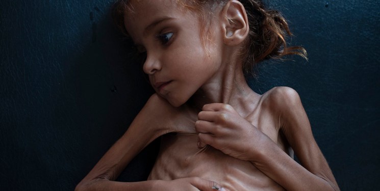 دختر بچه یمنی بالاخره از گرسنگی جان باخت +عکس