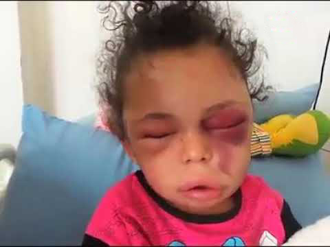 سرنوشت دختر ۵ ساله یمنی چه شد؟ +عکس