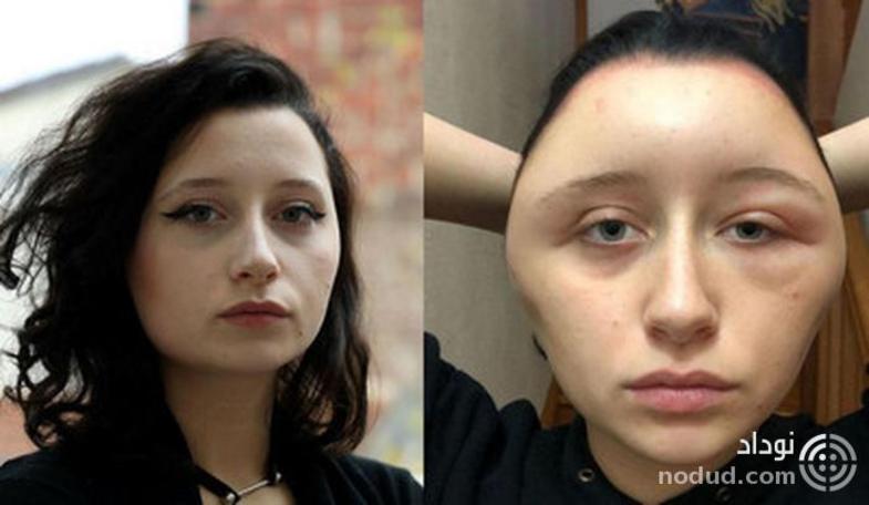 تغییر قیافه وحشتناک دختر جوان پس از مصرف رنگ موی تقلبی +عکس