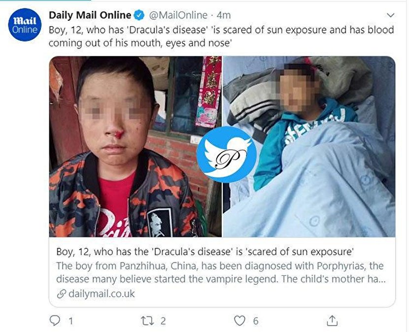 یک اتفاق نادر؛ پسربچه ۱۲ ساله چینی دراکولا شد!؟ +عکس