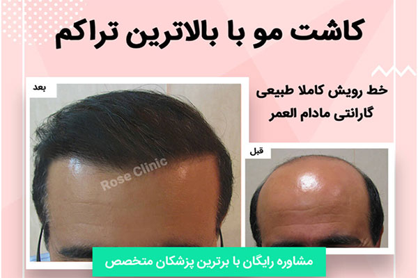 مراکز معتبر کاشت مو و ابرو در تهران