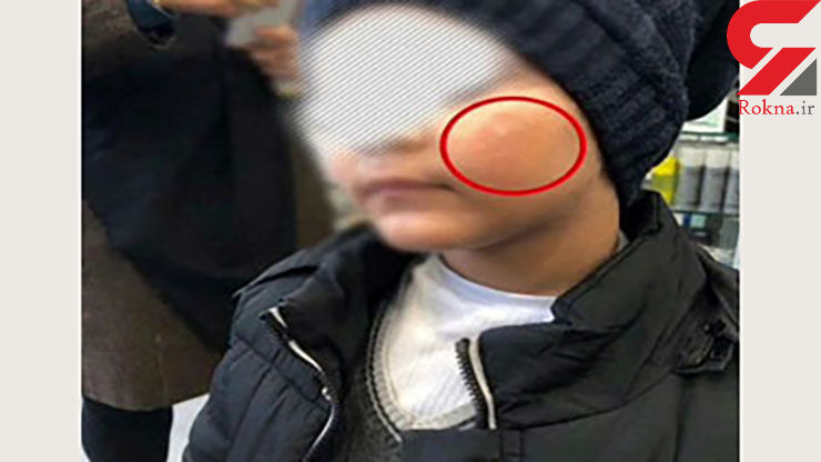 سوزاندن صورت پسر بچه با کفگیر در مهد کودک رامسر؟ +عکس