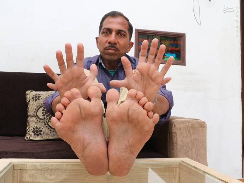 مرد هندی با دست و پا‌های ۷ انگشتی +عکس