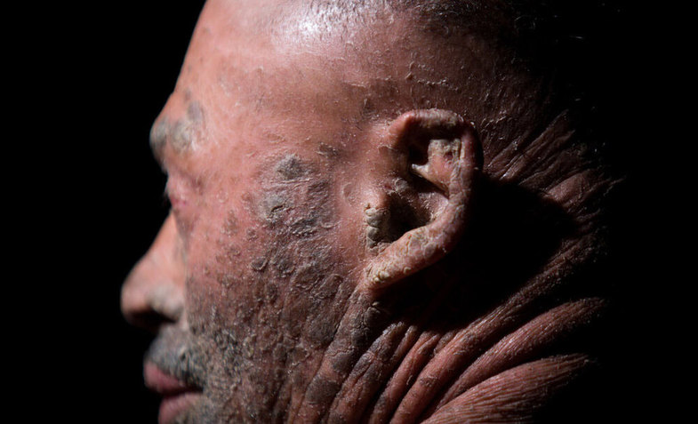 تصاویر دردناک از مردی با پوست پولکی در ایران +16