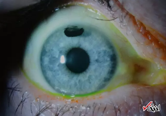 خالکوبی در چشم برای مبارزه با حساسیت به نور+عکس
