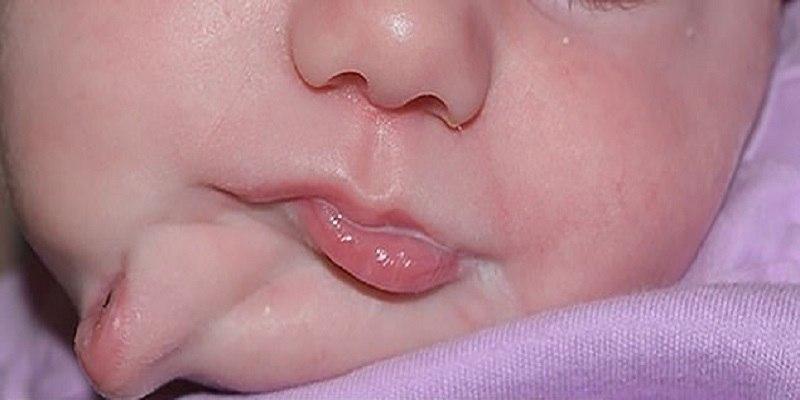 تولد نوزاد با دو دهان+تصویر