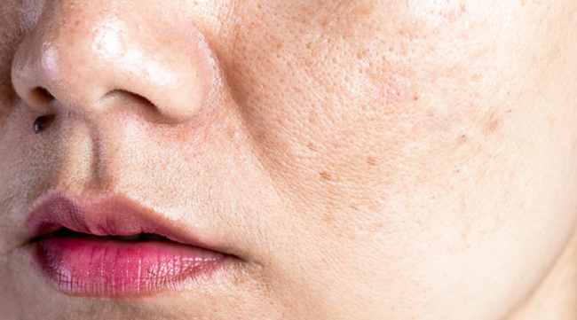 سیستئامین چیست و چرا بهترین ماده برای از بین بردن لک های پوستی است؟