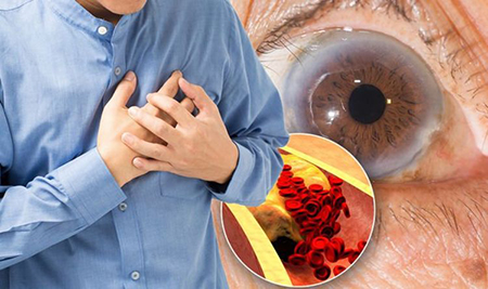 ۳ علامت اصلی بیماری قلبی که چشمان شما آن را آشکار می‌کند