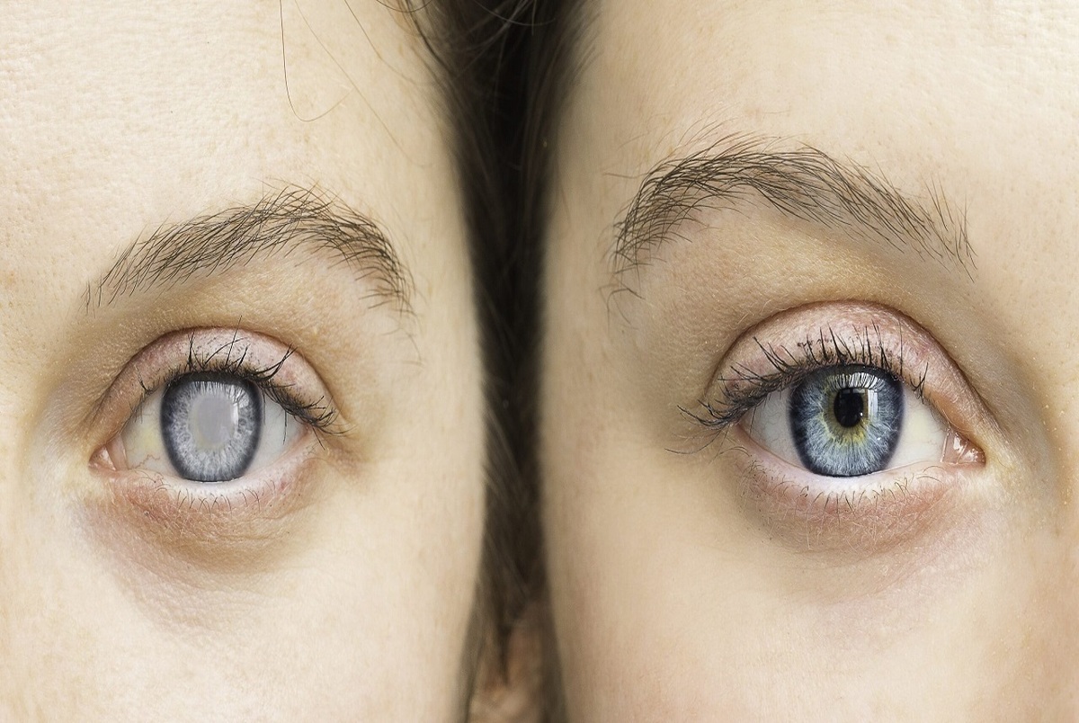 چگونه رنگ چشم ممکن است در زندگی تغییر کند؟