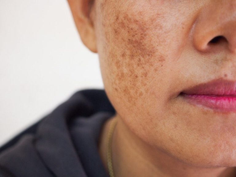 از جوش تا چین و چروک؛ رایج ترین مشکلات پوستی و نحوه درمان آن ها