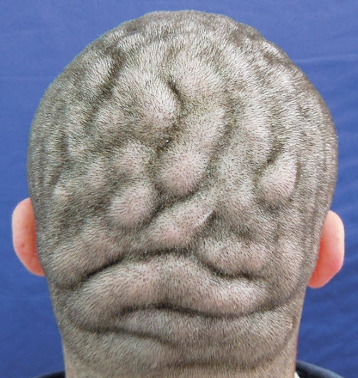 مردی که پوست سرش شبیه سطح مغز شده است