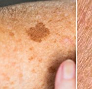تشخیص تفاوت لکه پیری بی ضرر با سرطان پوست