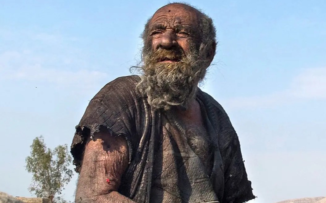 عمو حاجی -کثیف‌ترین مرد جهان- چند ماه پس از نخستین حمام برای اولین بار در ۶۰ سالگی، سال پیش درگذشت (یک پزشک)