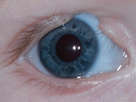 کولوبوم؛ همه چیز درباره این بیماری چشمی (بیتوته)