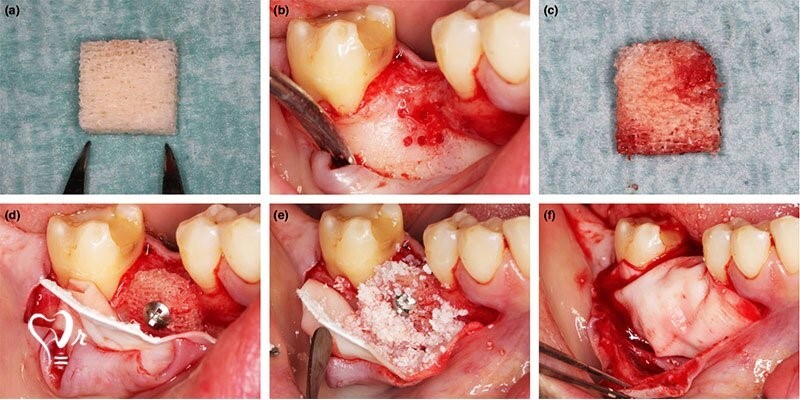 پیوند استخوان فک برای ایمپلنت دندان؛ هزینه بازسازی استخوان