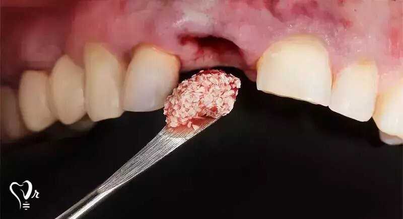 پیوند استخوان فک برای ایمپلنت دندان؛ هزینه بازسازی استخوان